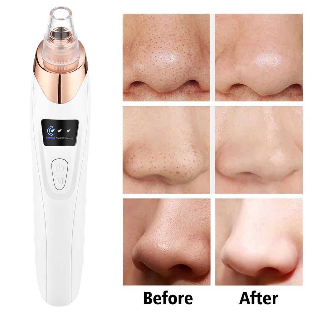 Electric Blackhead Remover Pore Vacuum – Facial Deep Cleansing Tool